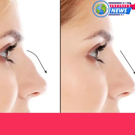 what is a hooked nose