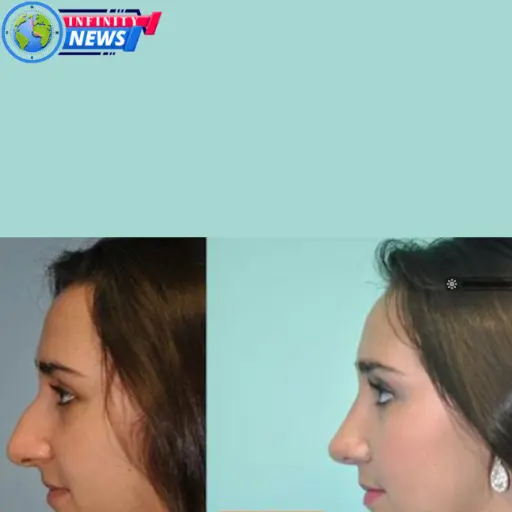 what is a hooked nose