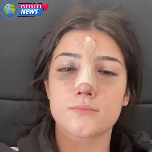 what is a hooked nose